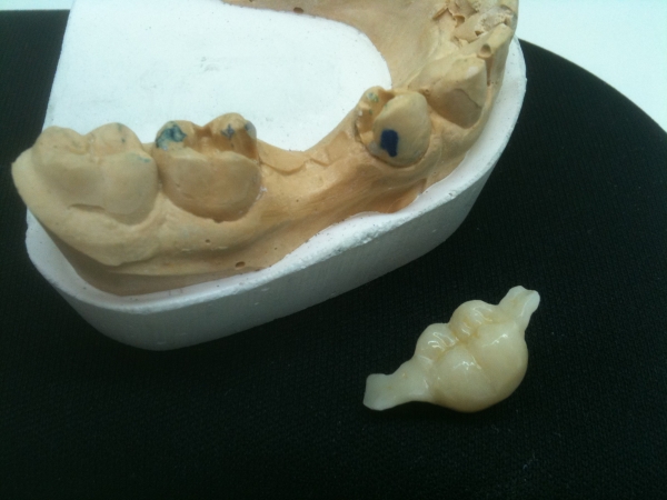 dientes-aguila-laboratorio | MOLINER 976 55 15 67 ** PRÓTESIS DENTAL  ZARAGOZA