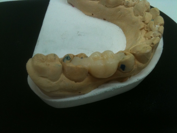 dientes-aguila-zaragoza | MOLINER 976 55 15 67 ** PRÓTESIS DENTAL ZARAGOZA